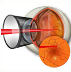 Лечение диабетической ретинопатия