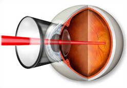 Лечение отслоения сетчатки глаза в ростове на дону thumbnail